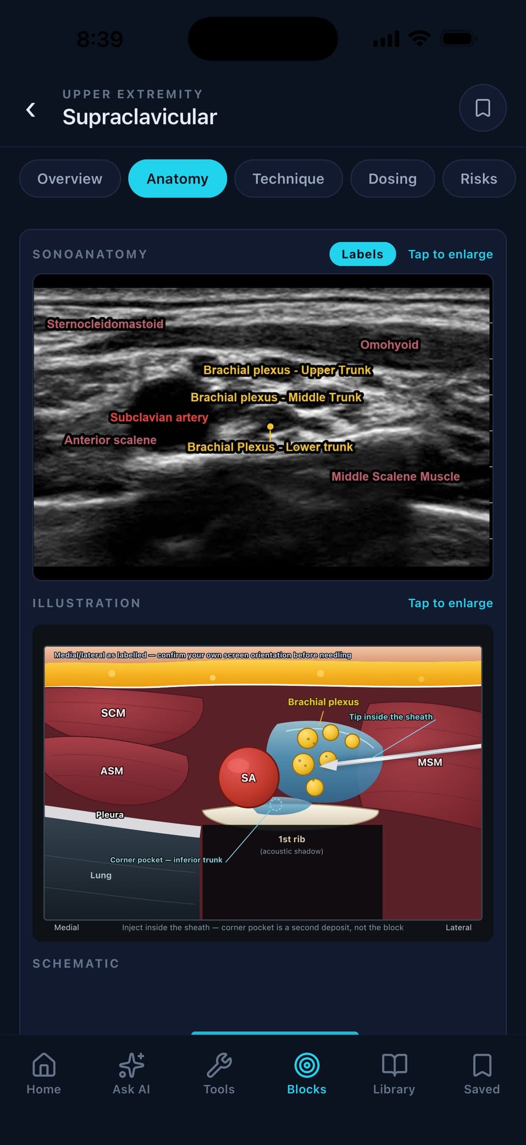 Interscalene block reference with anatomy, dose, indications, sources